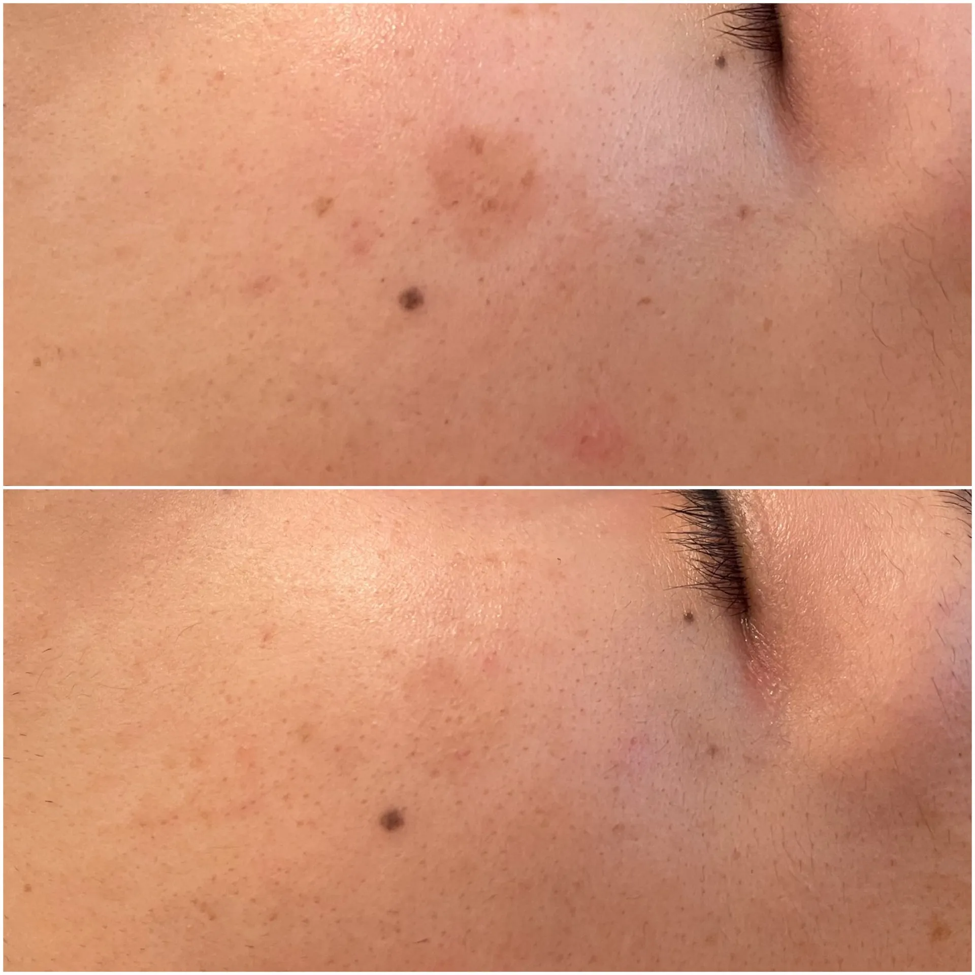 しみデトックス5回目