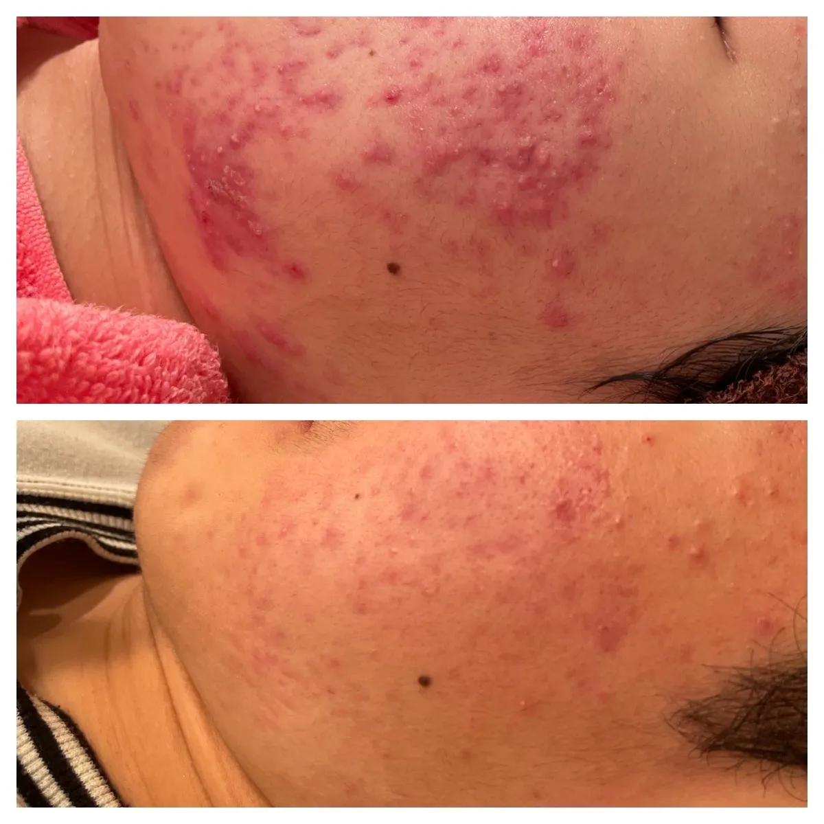 VOSサロンケアblack3回